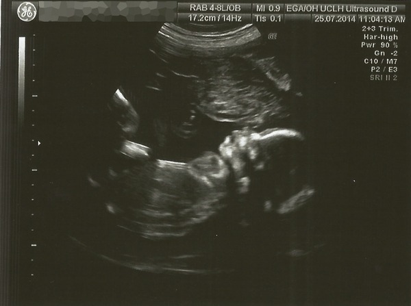 The shiny new Pregnant after MC due December 2014 thread #2