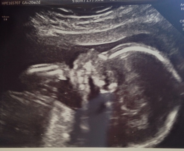 The shiny new Pregnant after MC due December 2014 thread #2