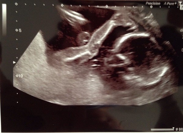 Any amusing pregnancy scan pictures?