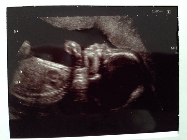 November 2014- Thread 6- Pink, blue or yellow? 20 week scans coming up for the rainbow collective