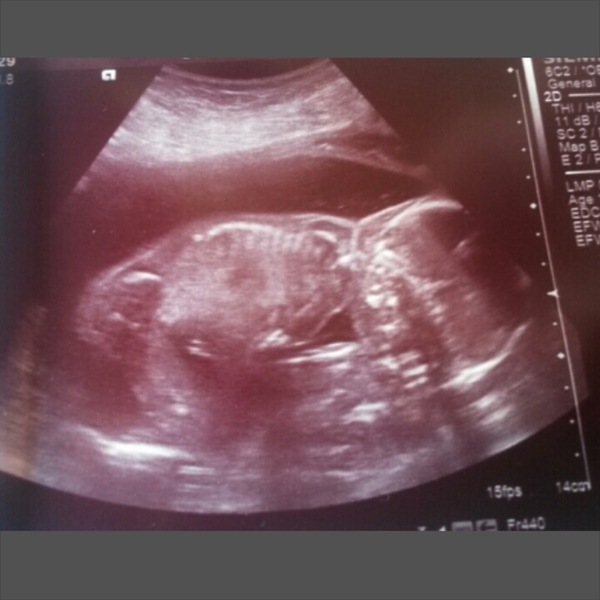 Dec 2014 Thread #5 - Battered and bruised we limp through the second trimester