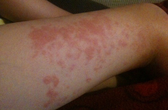 Really sore and itchy reoccurring rash on 6yo