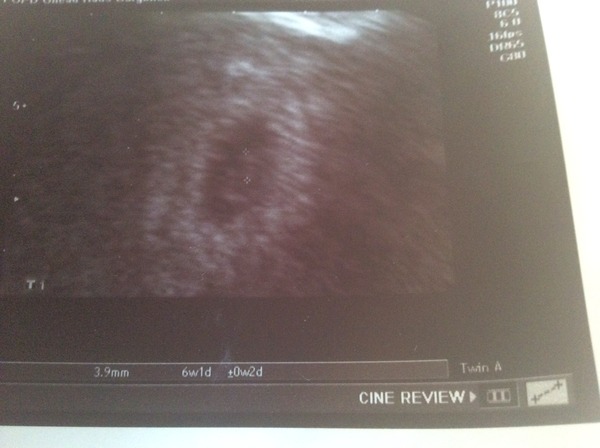 Pregnancy scan help