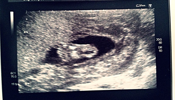 Dec 2014 Thread #5 - Battered and bruised we limp through the second trimester