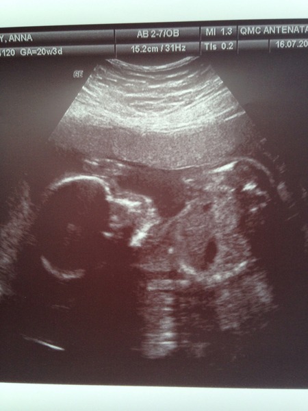 The shiny new Pregnant after MC due December 2014 thread #2