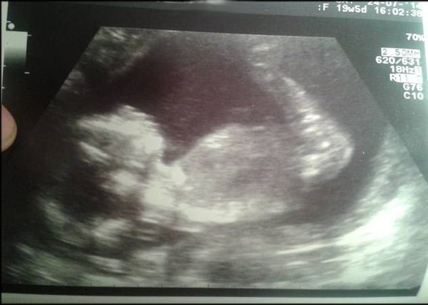 Dec 2014 Thread #5 - Battered and bruised we limp through the second trimester