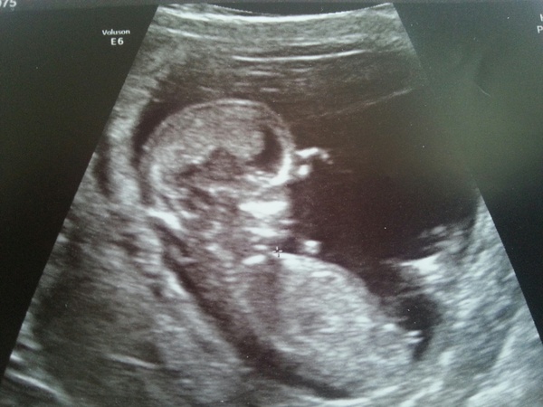 Leaving the first trimester behind and hopefully all the sickness and worry that has come with it. January 2015 thread #5