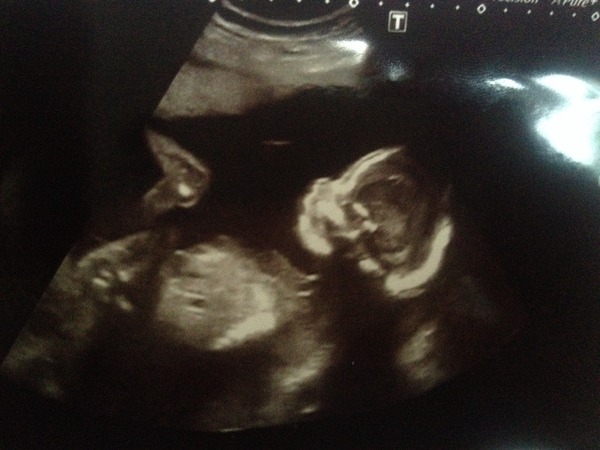 November 2014- Thread 6- Pink, blue or yellow? 20 week scans coming up for the rainbow collective