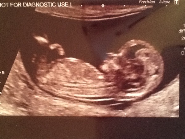 Leaving the first trimester behind and hopefully all the sickness and worry that has come with it. January 2015 thread #5