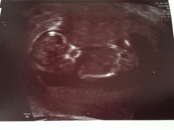 Leaving the first trimester behind and hopefully all the sickness and worry that has come with it. January 2015 thread #5