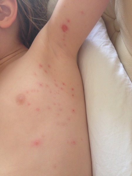 Advice needed - Chicken pox or Impetigo or both?