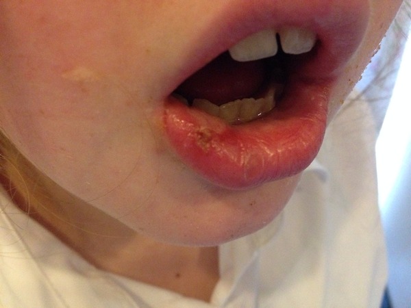 Do I need to worry - post dentist swelling?