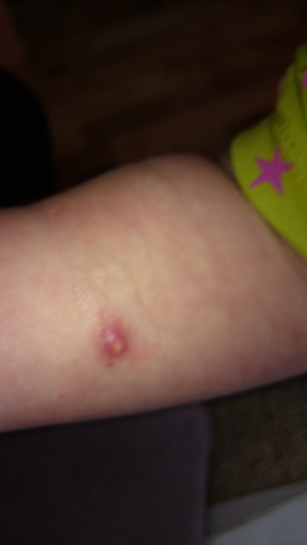 infected mollescum, leave or squeeze?