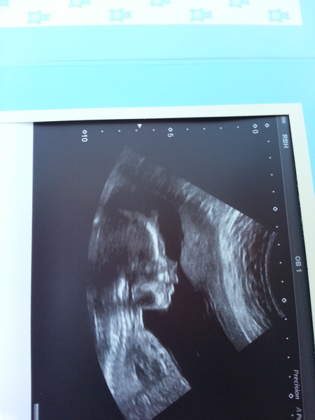 November 2014- Thread 6- Pink, blue or yellow? 20 week scans coming up for the rainbow collective