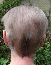 Zombie's  journey with breast cancer