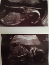 Dec 2014 Thread #5 - Battered and bruised we limp through the second trimester