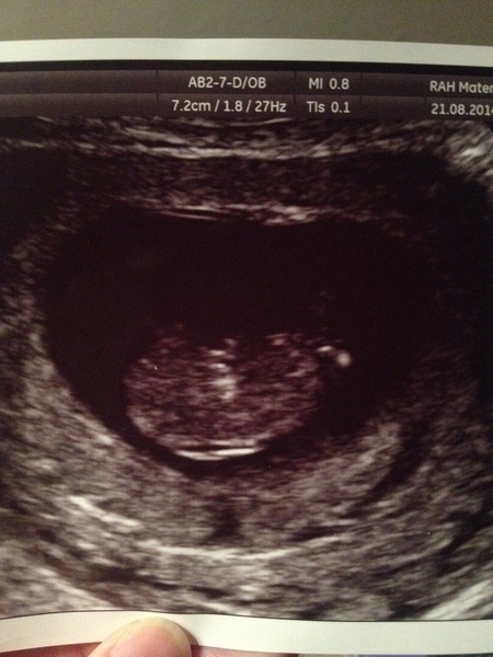 March Mummies 2015 - ever hopeful for the return of sanity and departure of sickness as we approach second tri!