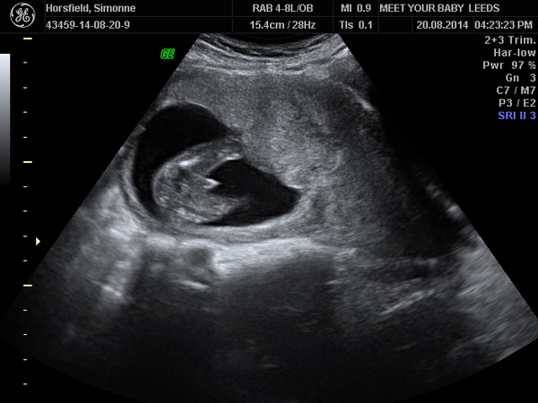 Has anyone had a private gender scan at 16/17 weeks and how accurate do you think it is??