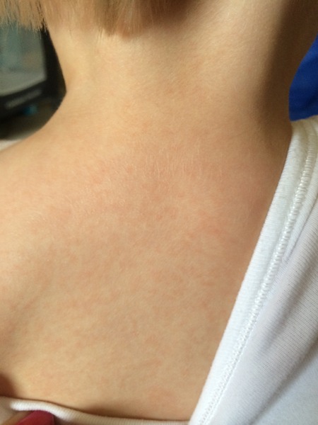 Does this look like chicken pox to you?