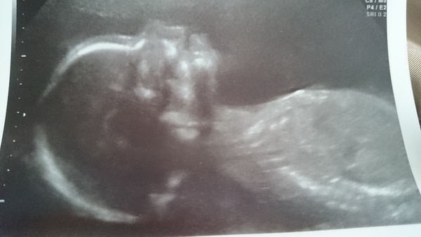 January 2015 - More scans, kicks, hiccups and glowiness - thread #8