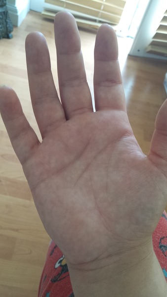 swelling!!