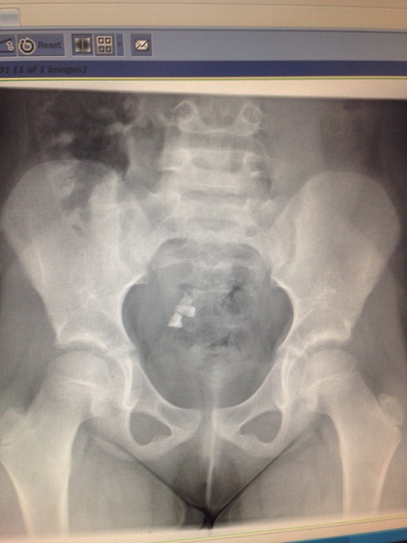 Ovarian dermoid cyst 7 year old daughter