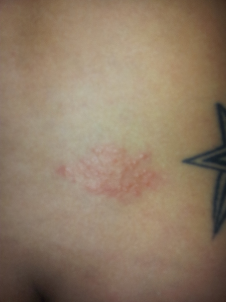 Can anyone diagnose this patch of bumps on my back?
