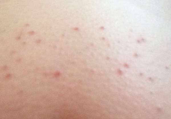 Does this look like ingrown hairs?