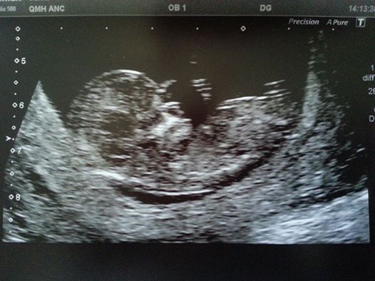 March Mummies 2015 - ever hopeful for the return of sanity and departure of sickness as we approach second tri!