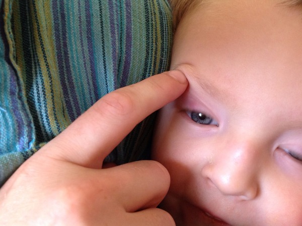 Toddler eyelid purple