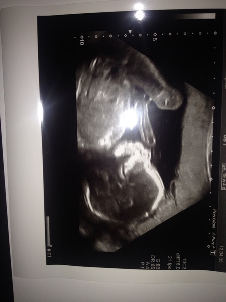 Had my 20 week scan