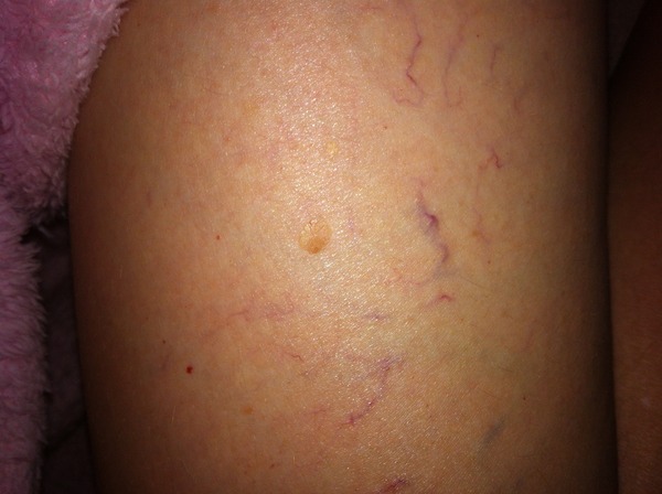 Could someone please take a look at this for me. Any dermatology experts?