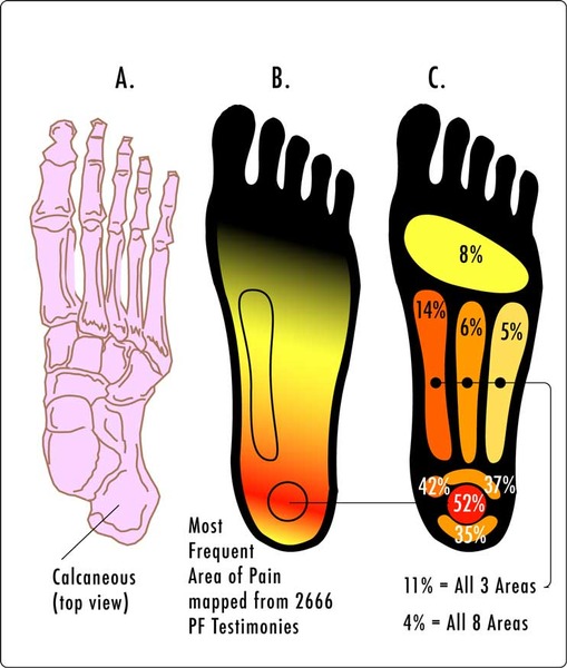 Foot pain - Anyone want to play Dr and diagnose me?!