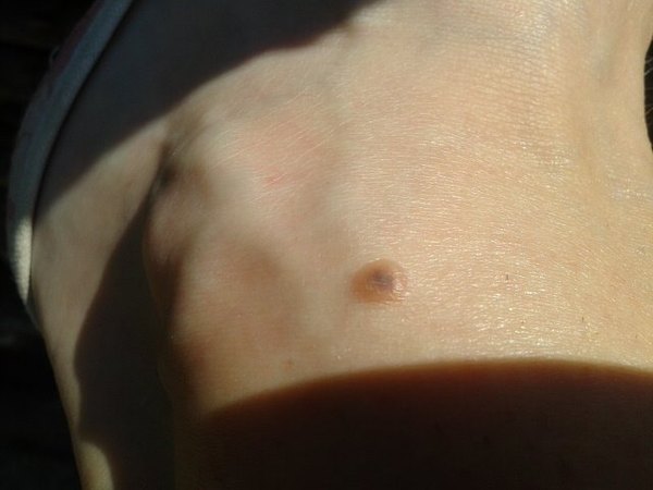 Mole - can someone help?