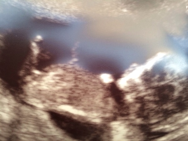 Just had a gender scan...who would like to guess from the pic :)