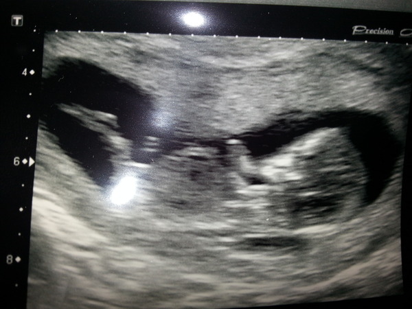 March Mummies 2015 - ever hopeful for the return of sanity and departure of sickness as we approach second tri!