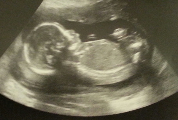 Boy or Girl?