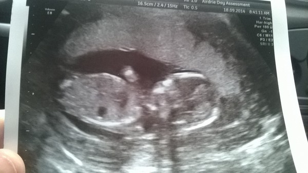 March Mummies 2015 - to second tri and beyond we go, bumps appearing and sickness (hopefully) disappearing