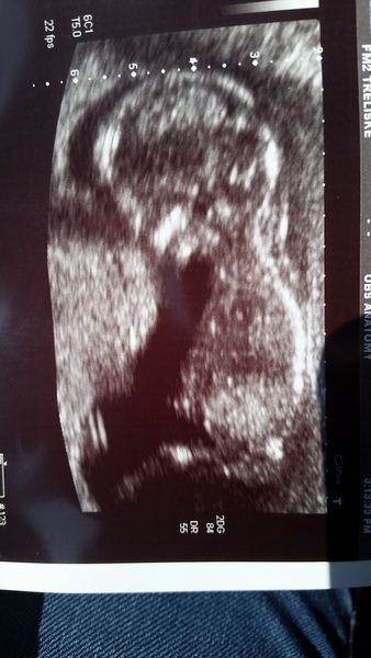 Hey anyone good at seeing nubs on scans and guessing the gender please