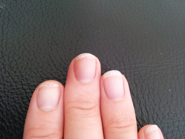 nails in a state, what can be done?