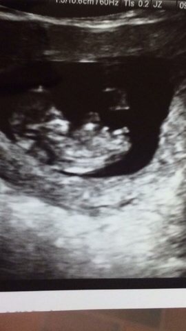 Gender prediction ultrasound boy or girl??!! :)