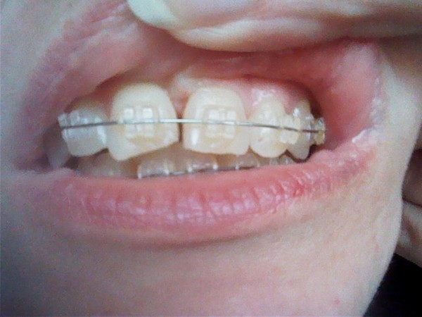 To insist my dentist to put my front teeth back as they were?