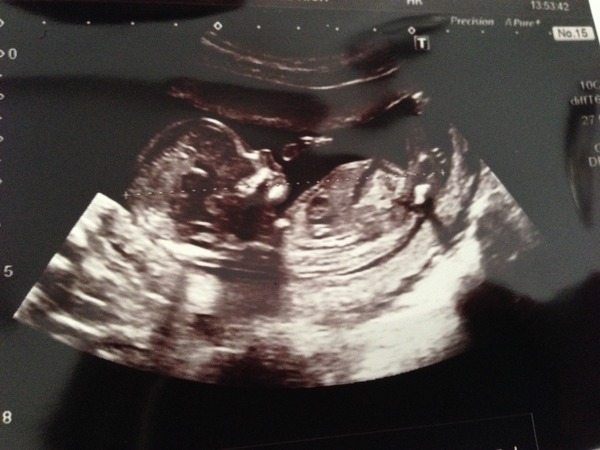 March Mummies 2015 - to second tri and beyond we go, bumps appearing and sickness (hopefully) disappearing