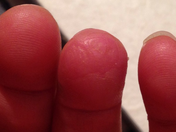 Anyone want to diagnose my (slightly) gruesome skin condition (on my finger!)