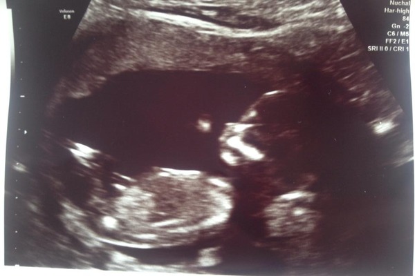 March Mummies 2015 - to second tri and beyond we go, bumps appearing and sickness (hopefully) disappearing