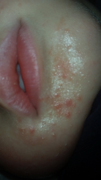 Skin Problem...Please help!