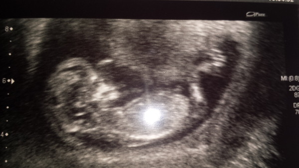 March Mummies 2015 - to second tri and beyond we go, bumps appearing and sickness (hopefully) disappearing