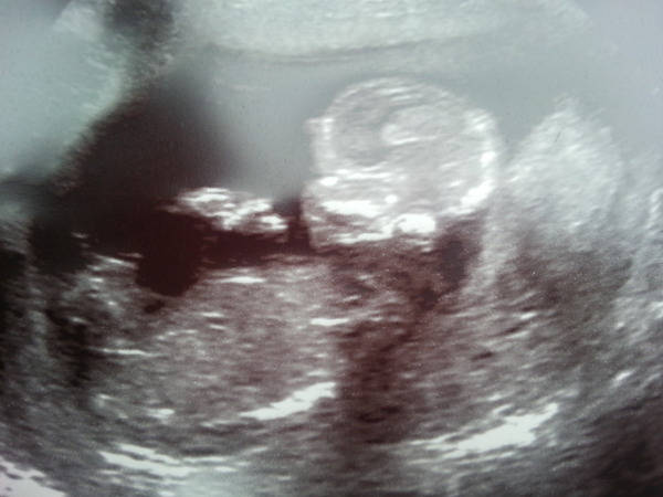 March Mummies 2015 - ever hopeful for the return of sanity and departure of sickness as we approach second tri!