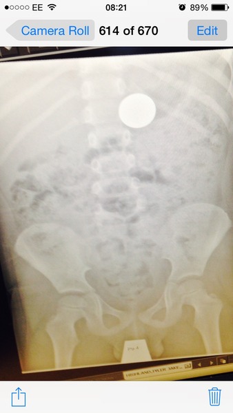 5 year old swallowed a 10p coin