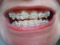 To insist my dentist to put my front teeth back as they were?